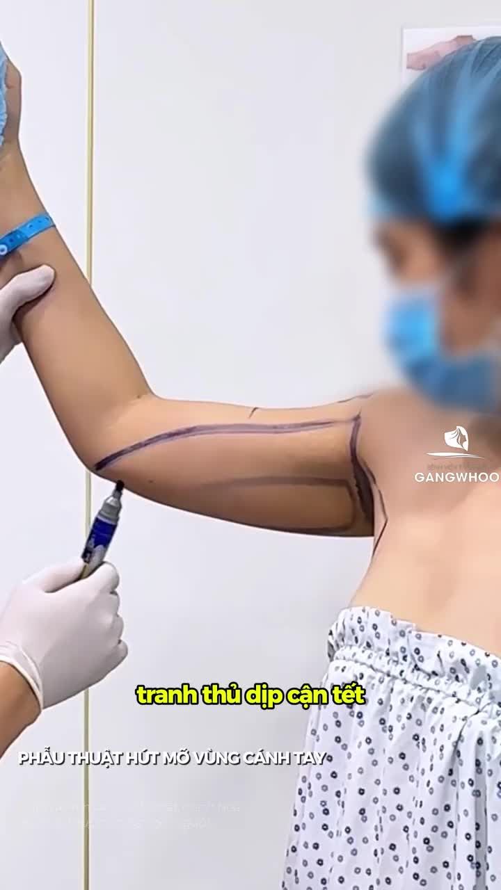 Tết đến thích gì mặc đó, chị em tranh thủ đến Gangwhoo phẫu thuật hút mỡ vùng cánh tay liền nhe