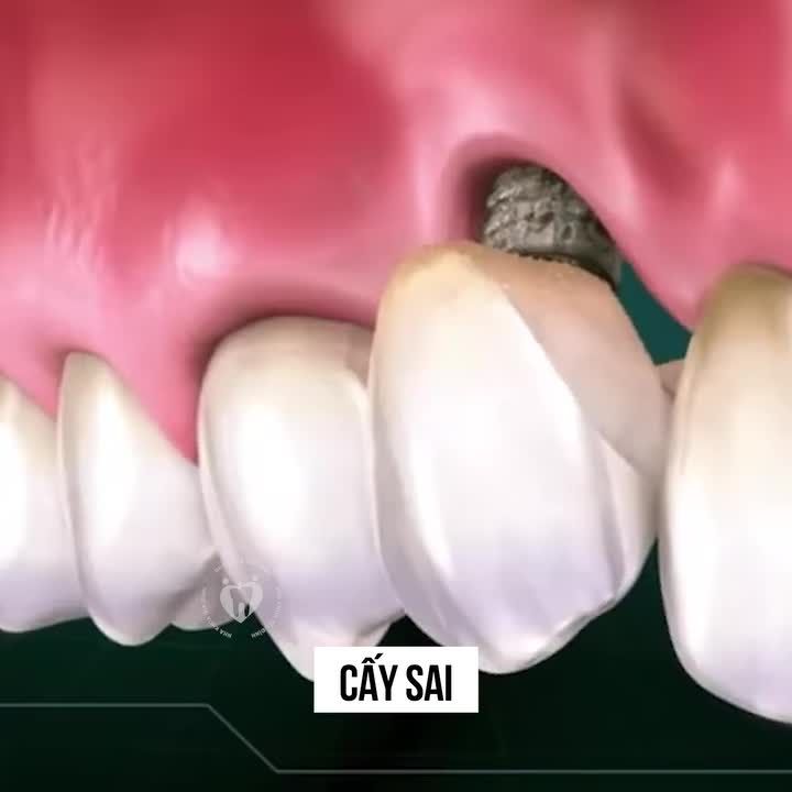 TIẾT KIỆM VÀI TRIỆU LÚC ĐẦU, NHƯNG NẾU GẶP BIẾN CHỨNG CHI PHÍ ĐIỀU TRỊ CÓ THỂ GẤP NHIỀU LẦN