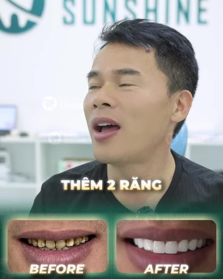 Sau hơn 2 năm sử dụng răng sứ tại Sunshine, anh khách hàng quay lại tái khám và… quyết định làm thêm 2 răng sứ. (Tổng 22 răng)