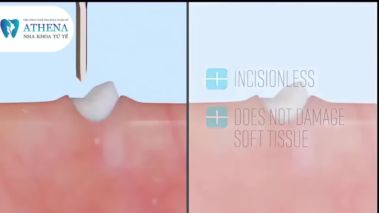 SO SÁNH NHỔ RĂNG THƯỜNG NHỔ RĂNG BẰNG CÔNG NGHỆ SÓNG SIÊU ÂM PIEZOTOME