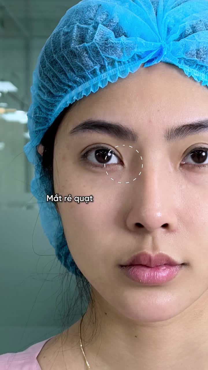 Tạm biệt cảm giác thiếu tự tin vì nếp mí nhỏ