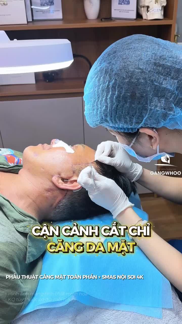 Cận cảnh cắt chỉ của anh khách Quốc Tế sau phẫu thuật căng mặt toàn phần + Smas nội soi 4K