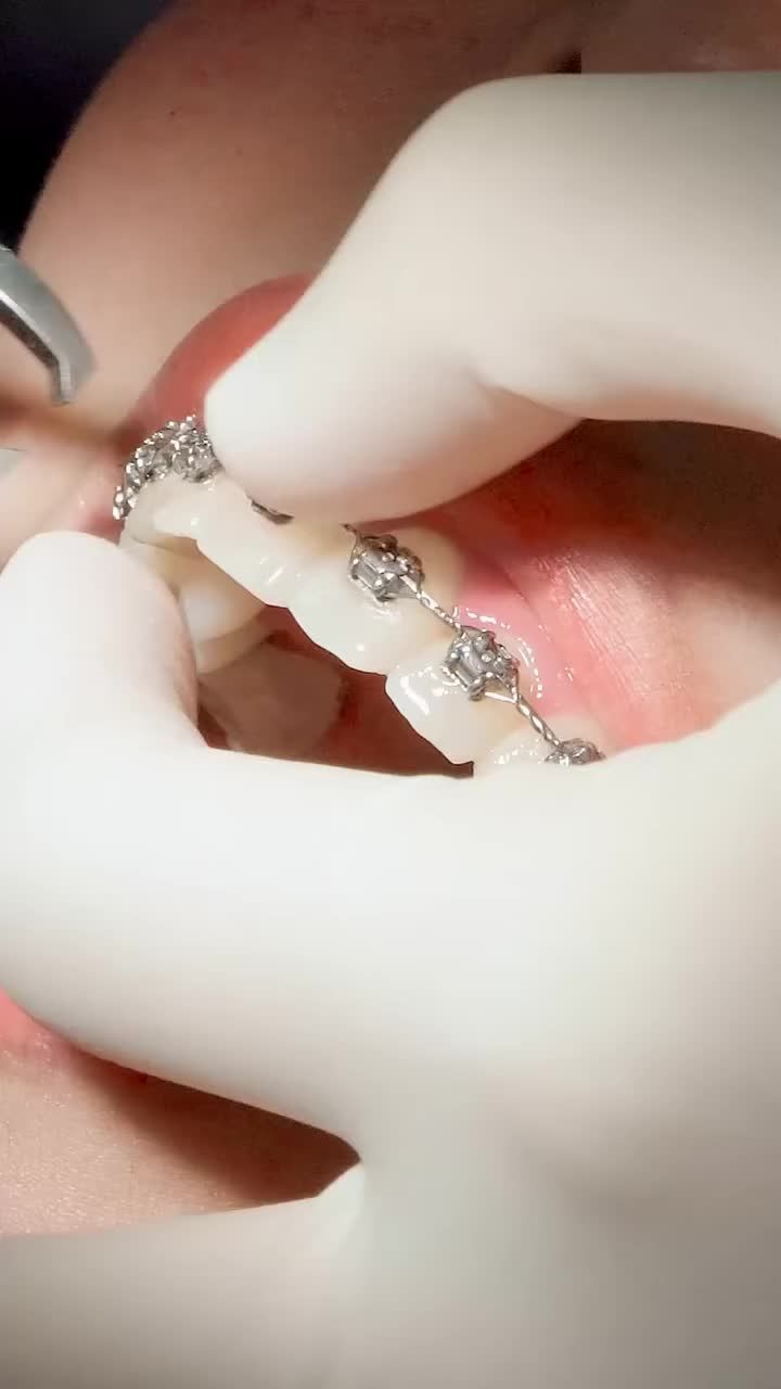 Cách để khiến một cô gái xinh đẹp, đáng yêu như này cười mỗi ngày thì chỉ có thể là niềng răng thui!