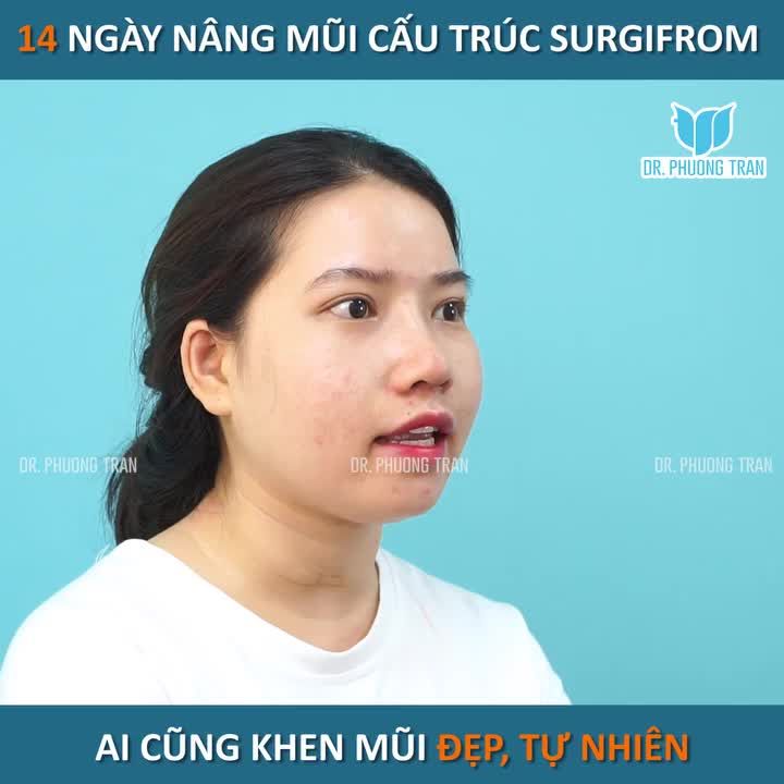 14 NGÀY SAU NÂNG MŨI CẤU TRÚC SURGIFROM, AI GẶP CŨNG KHEN DÁNG MŨI TỰ NHIÊN — HÀI HÒA