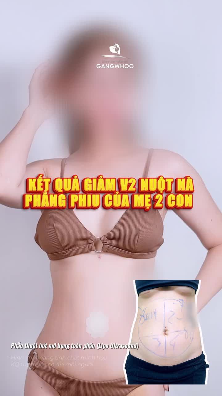 Kết quả giảm v2 nuột nà phẳng phiu của mẹ 2 con