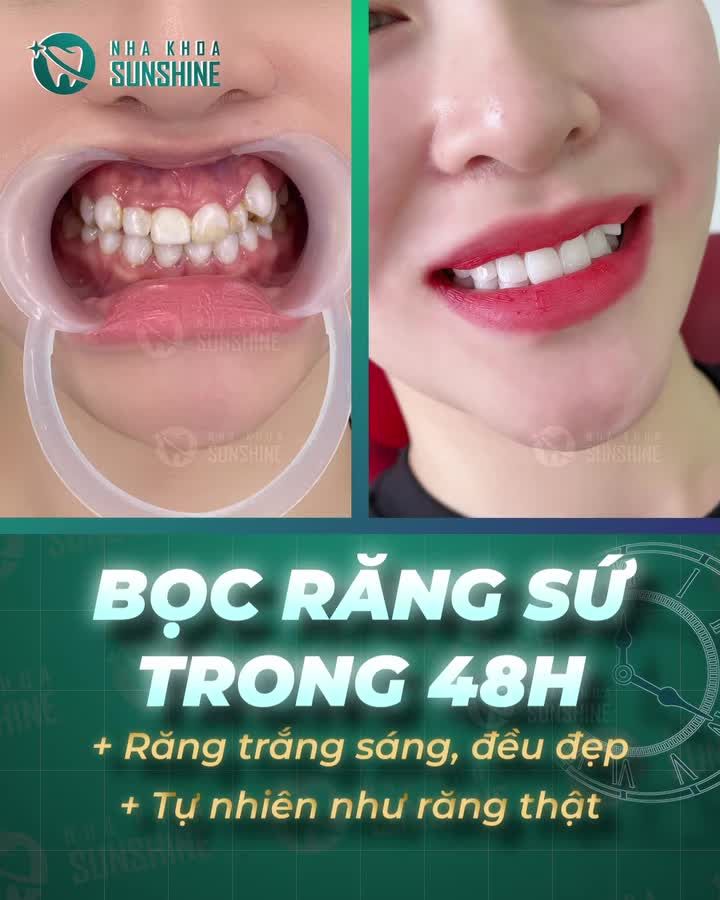 Phương pháp bọc răng sứ giữ nguyên răng khểnh duyên dáng: KHÔNG ĐAU – KHÔNG MÀI NHỎ - 48H HOÀN THIỆN