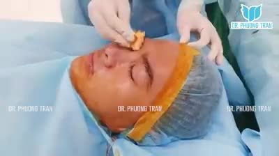Nâng mũi xong, bạn ấy soi gương và cứ mỉm cười mãi