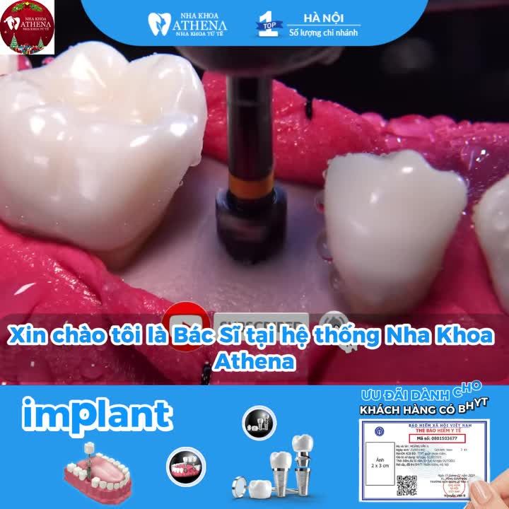 RĂNG IMPLANT CÓ TỐT NHƯ RĂNG THẬT KHÔNG?