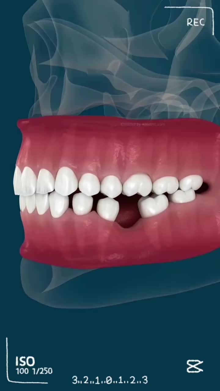 Mất răng càng lâu – tiêu xương càng nhanh! Kiểm tra ngay trước khi quá muộn