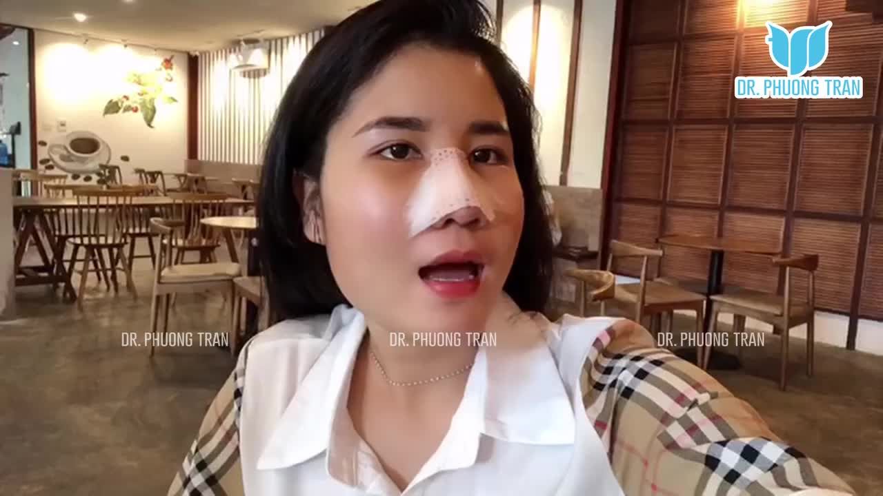 2 ngày đi xe khách, 3 ngày đi cà phê sau nâng mũi sẽ thế nào?
