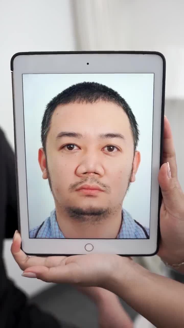 THÀNH CÔNG "GIẢI CỨU" DÁNG MŨI BỊ BIẾN CHỨNG DO TAI NẠN LAO ĐỘNG | KH. DUY KHƯƠNG (VIỆT KIỀU MỸ)