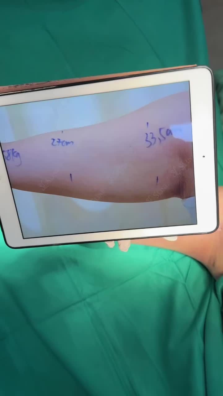 VÌ SAO NHIỀU CHỊ EM TÌM ĐẾN HÚT MỠ CÁNH TAY?