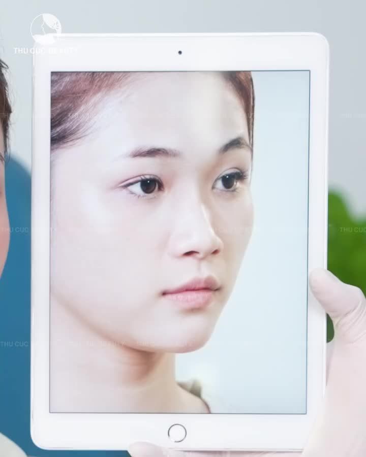 Nâng mũi Thu Cúc – Nâng cấp sự an toàn và vẻ đẹp tự nhiên