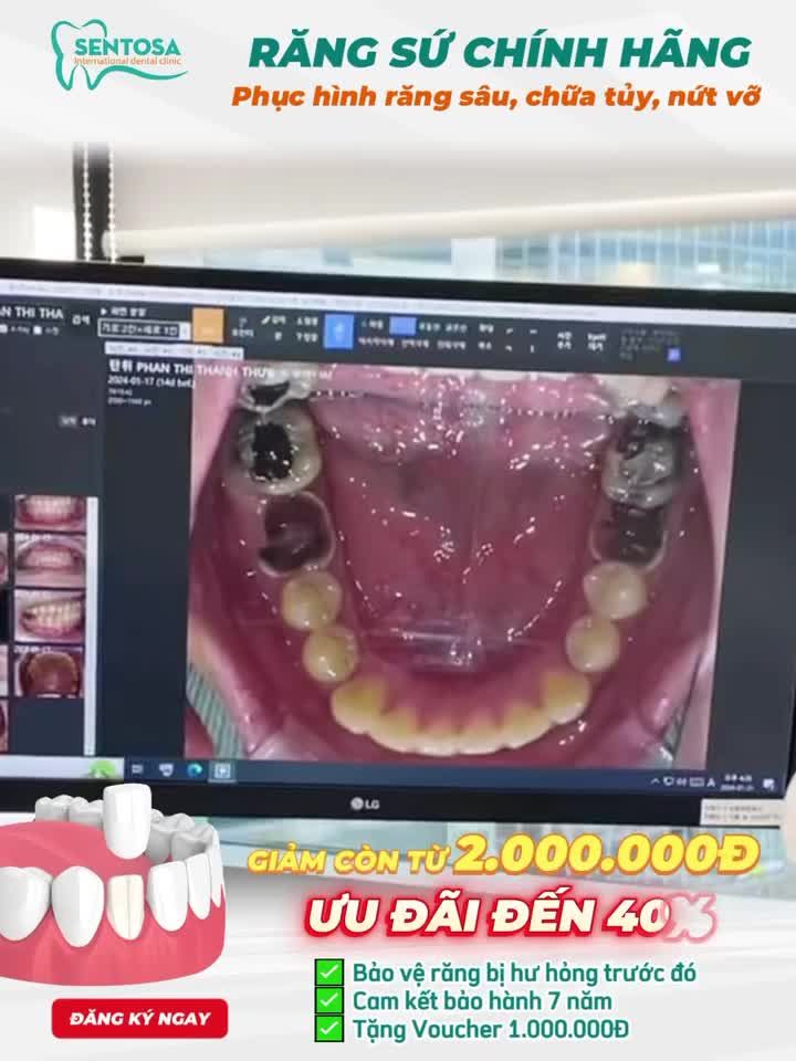 RĂNG SỨ CHUẨN Y KHOA – GIẢM ĐẾN 40%, CHỈ CÒN TỪ 2.000.000Đ
