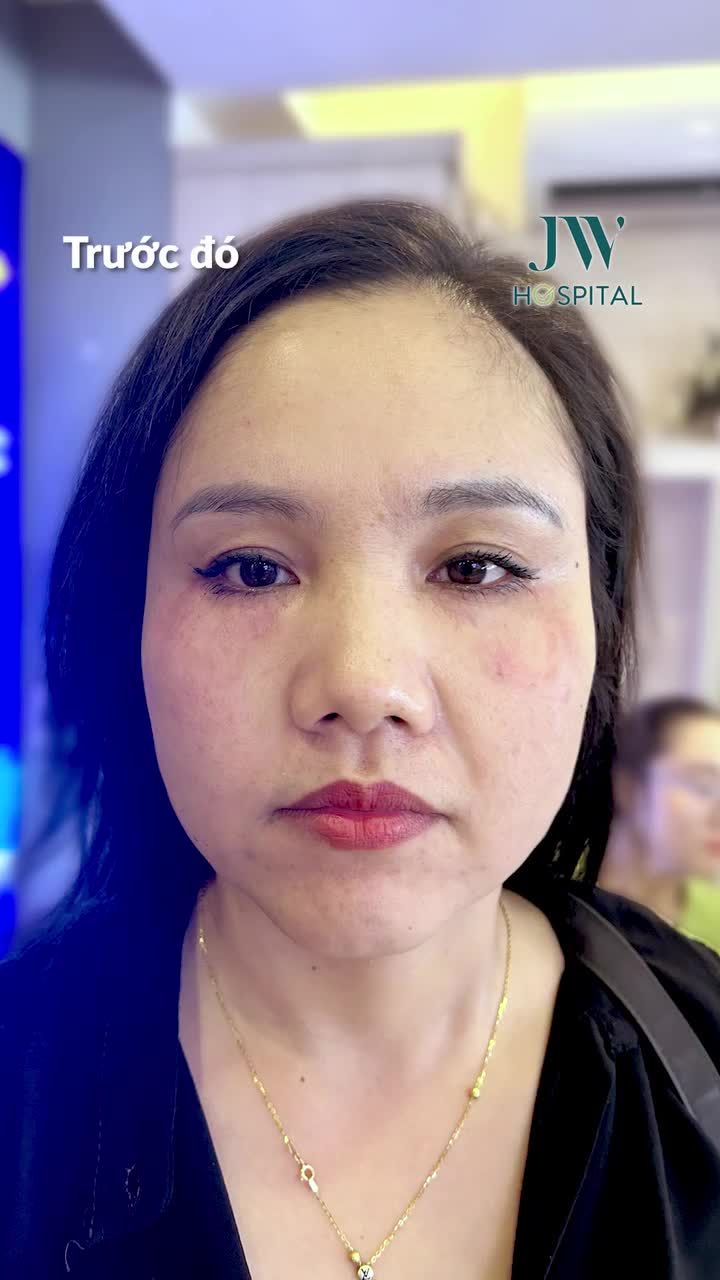 XÓA CHẢY XỆ CHỊ GÁI U40 DA SĂN CHẮC, TRẺ 10 TUỔI SAU 45 PHÚT NÂNG CƠ HIFU SMAS TẠI JW ĐẸP ĐÓN TẾT