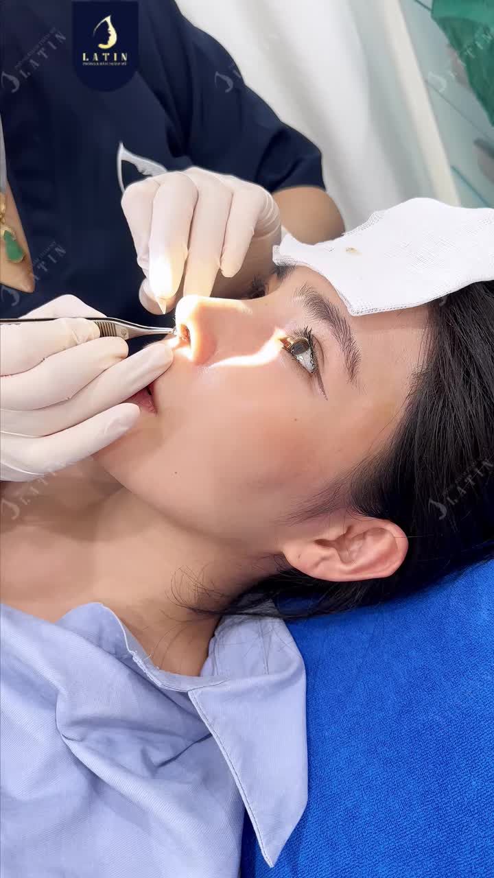 NẰM YÊN CẮT CHỈ, MŨI MỚI LÊN HÌNH HOÀN MỸ