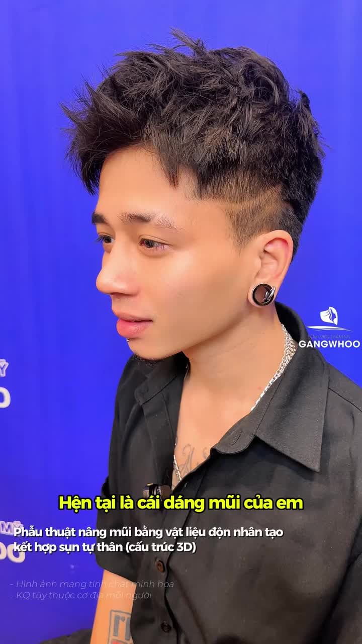 Đẹp trai hơn cả Hoa Vinh sau khi phẫu thuật nâng mũi bằng vật liệu độn nhân tạo kết hợp sụn tự thân (cấu trúc 3D)