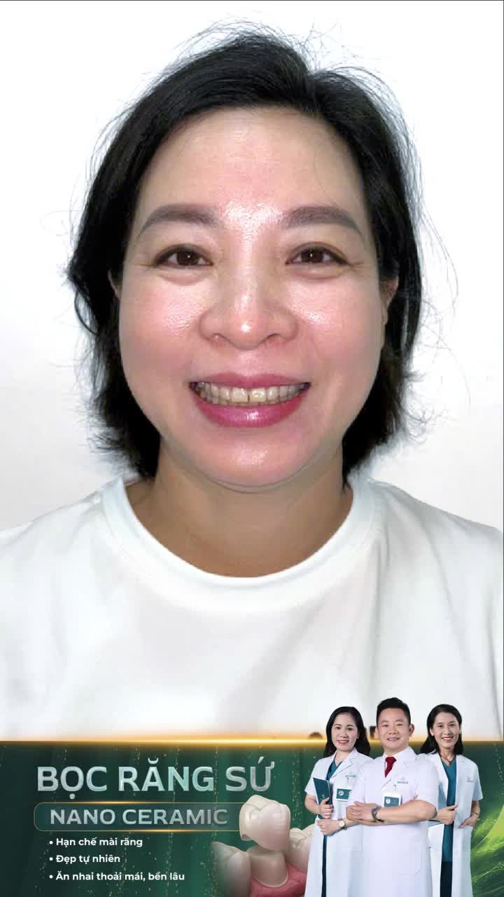 Trẻ ra 10 tuổi sau bọc răng sứ