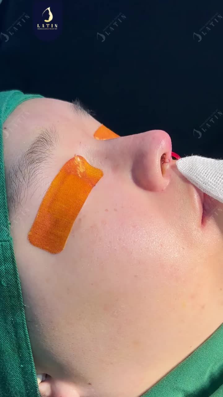 CHIẾC MŨI ĐÃ THAY ĐỔI GÓC NGHIÊNG NHƯ THẾ NÀO?