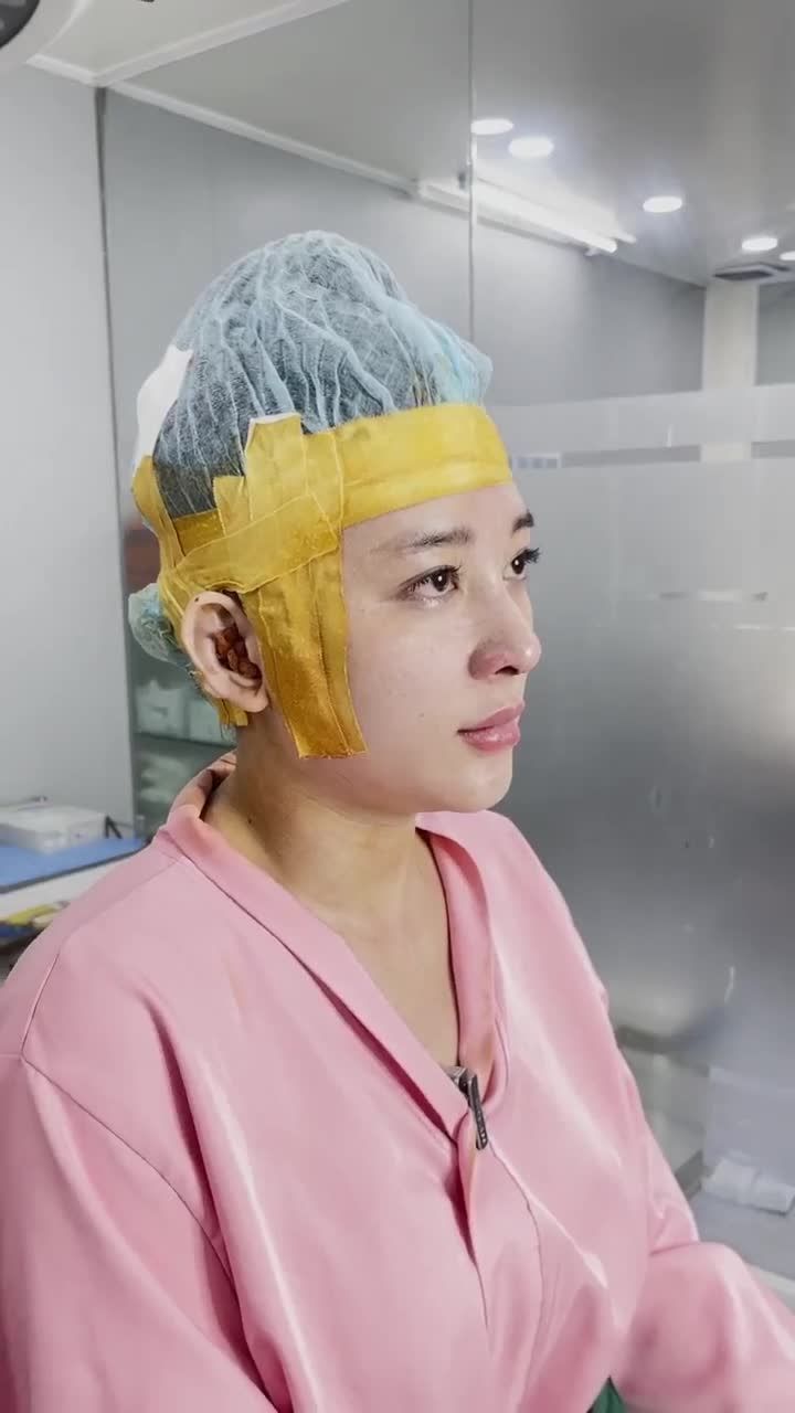 KẾT QUẢ SAU 60 PHÚT XỬ LÝ FILLER - NÂNG CAO DÁNG MŨI