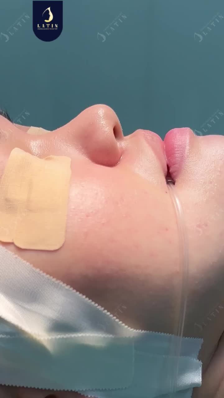 TẠI SAO NÓI NÂNG MŨI LÀ LỐI TẮT DẪN ĐẾN SỰ XINH ĐẸP