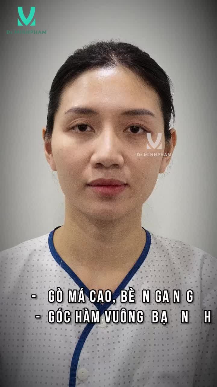 GỌT HÀM HẠ GÒ MÁ Gương mặt thay đổi rõ rệt sau 15 ngày Mời cả nhà cùng xem video để cảm nhận sự khác biệt!