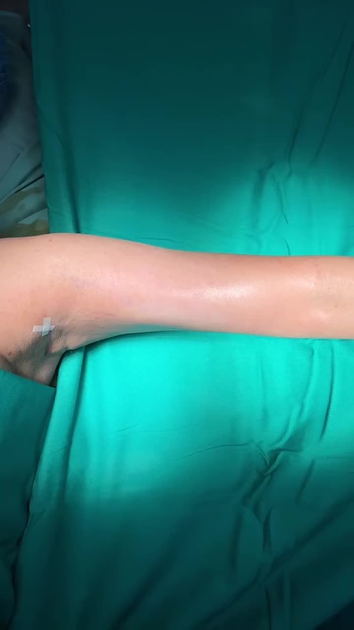 MIỄN PHÍ HÚT MỠ NÁCH KHI HÚT MỠ CÁNH TAY