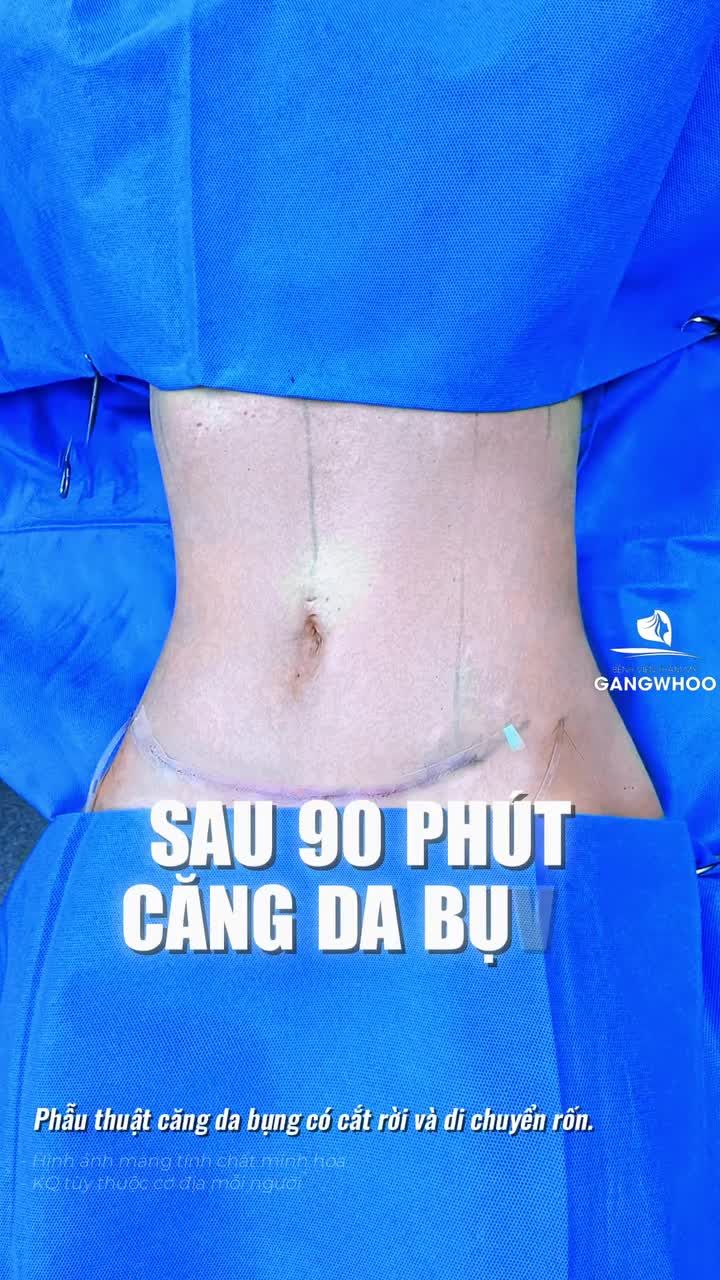 Ứng dụng công nghệ nội soi 4K và phẫu thuật căng da bụng có cắt rời và di chuyển rốn giúp kết quả sau 90 phút của khách Quốc tế Úc tối thiểu xâm lấn, nhanh hồi phục và tối ưu tính thẩm mỹ của vùng rốn.