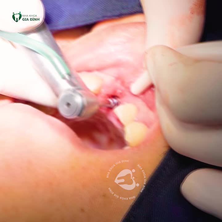 TRỒNG RĂNG IMPLANT HÔM NAY - CÓ NGAY RĂNG MỚI TRƯỚC TẾT