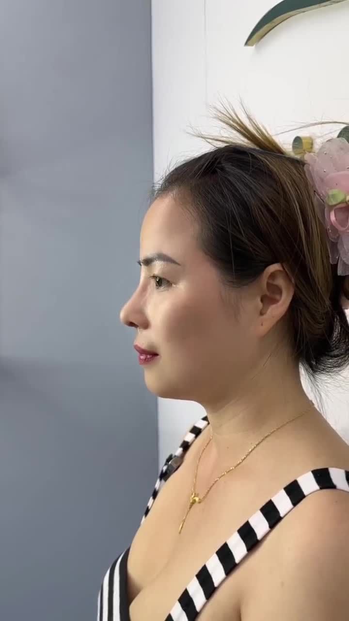 GẶP LẠI CHỊ KHÁCH VIỆT KIỀU ĐÀI LOAN SAU 9 NGÀY NÂNG MŨI CẤU TRÚC