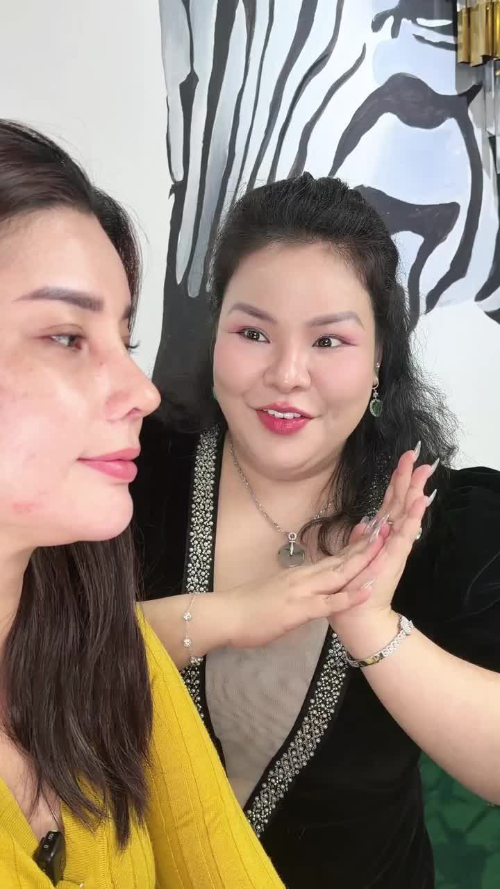 Nâng mũi sụn sườn - Sau 10 ngày tái khám - Dáng mũi đẹp xuất sắc, cực phù hợp giúp tôn lên đường nét xinh đẹp cho khách hàng.