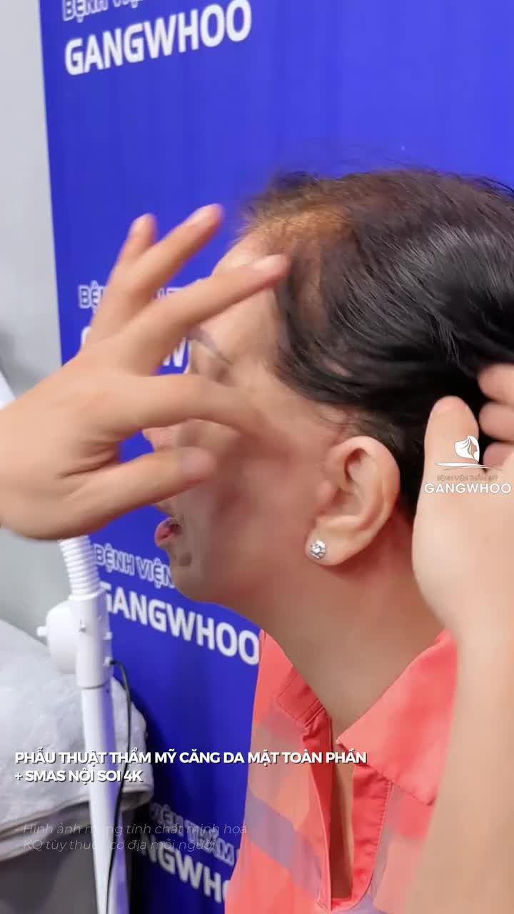 Kết quả đường sẹo sau 1 tháng phẫu thuật căng da mặt toàn phần + Smas nội soi 4K