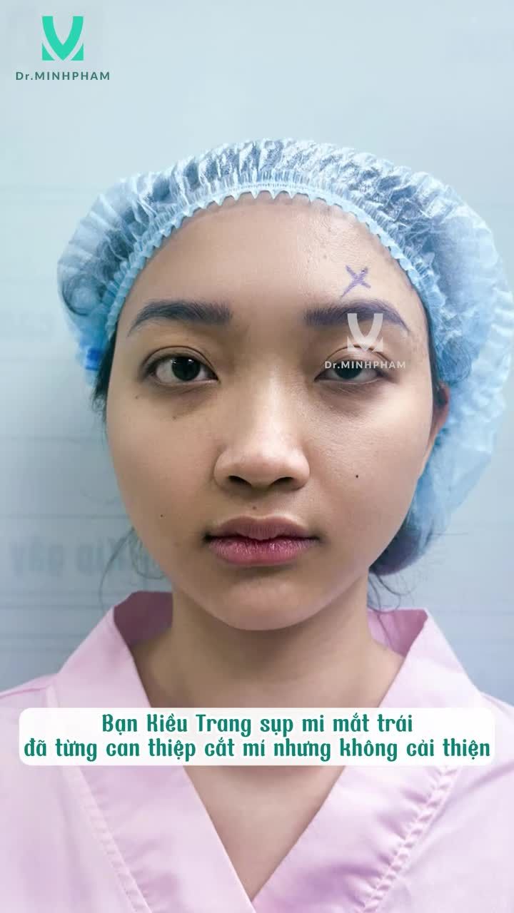 Phẫu thuật sụp mi bẩm sinh đã thay đổi bạn Kiều Trang như thế nào?