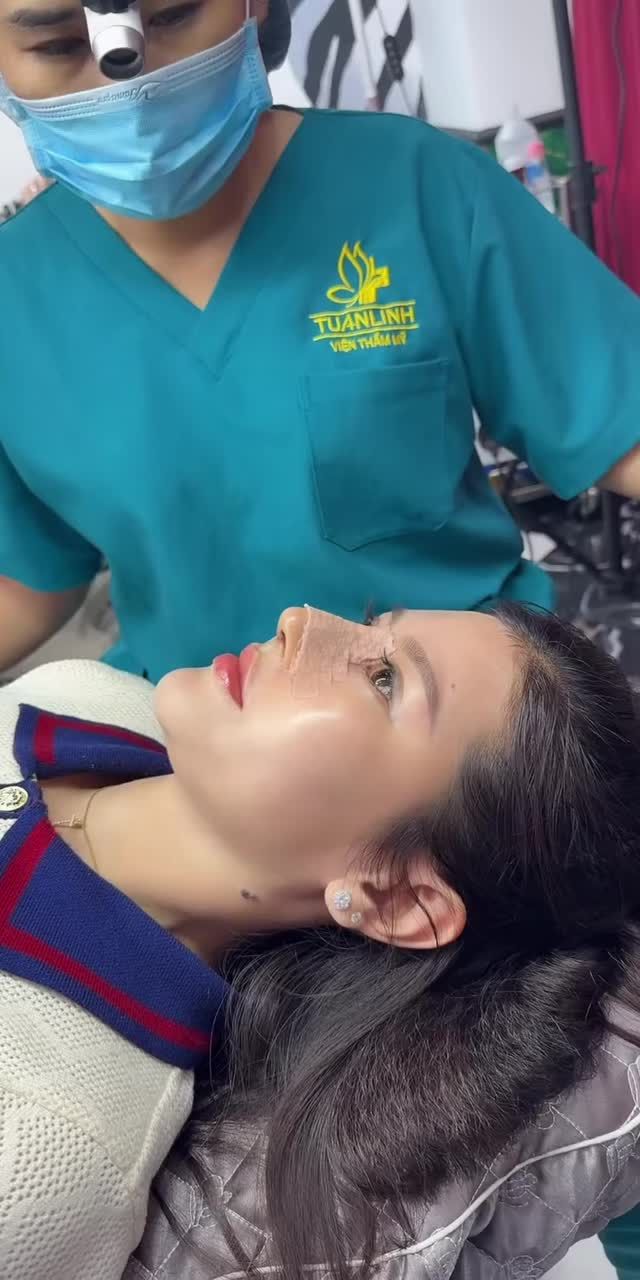 Mũi cấu trúc bọc cân cơ thái dương được 5 ngày