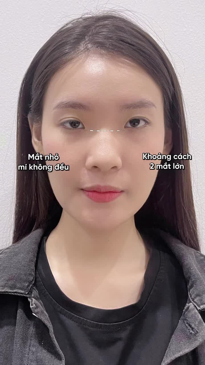 "Cắt mí xong em cảm thấy hối hận Hối hận vì không đến Tấm cắt mí sớm hơn"