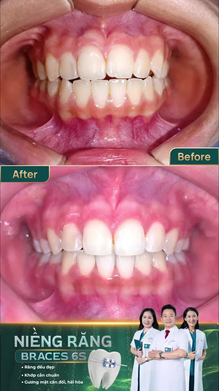 Niềng răng đã giúp tôi thay đổi thế nào