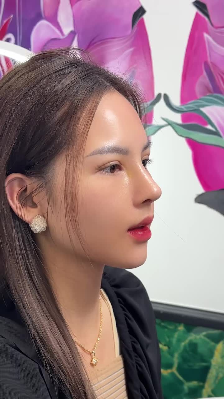 Mũi cấu trúc surgiform sau 10 ngày