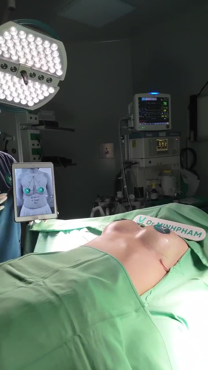 Mentor Boost lên dáng cực “MƯỚT”  Size 320cc – Đường quầng siêu giấu sẹo