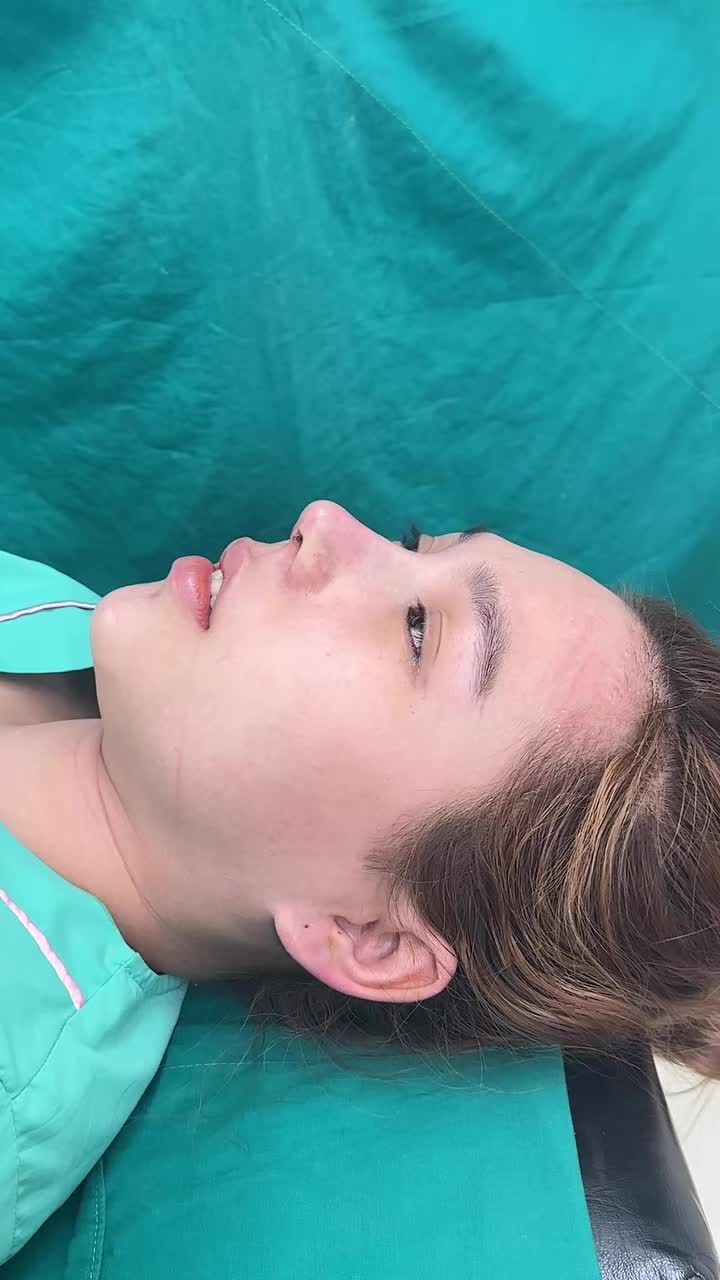 Case nâng mũi cấu trúc surgiform vừa hoàn thành