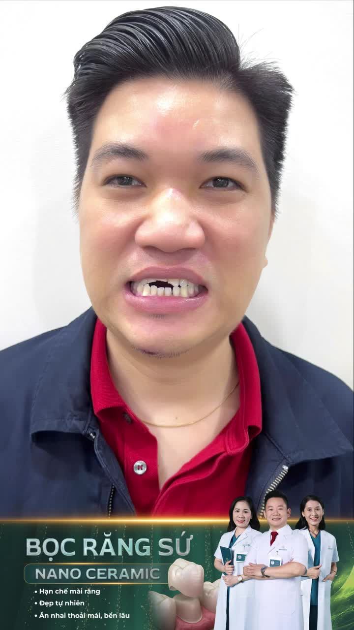 Chẳng lo răng sứt, sua bọc răng sứ