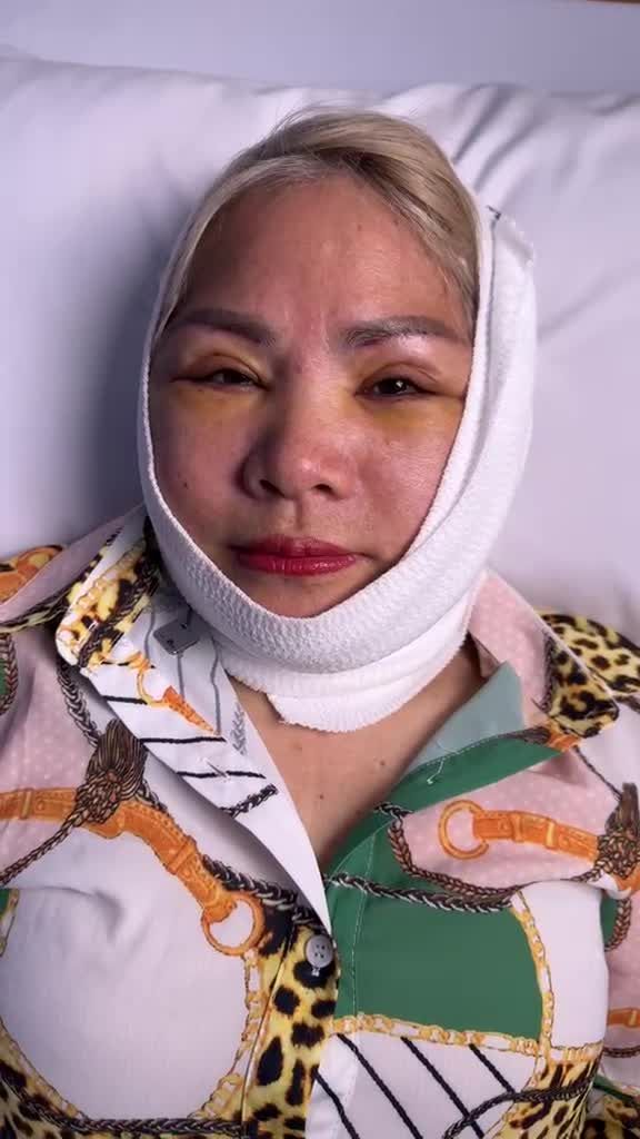 Việt kiều Mỹ U60 TRẺ RA 20 tuổi đáng kinh ngạc sau COMBO TREO CUNG MÀY, MIDFACE 3IN1 và CĂNG DA MẶT SMAS PRO tại JW