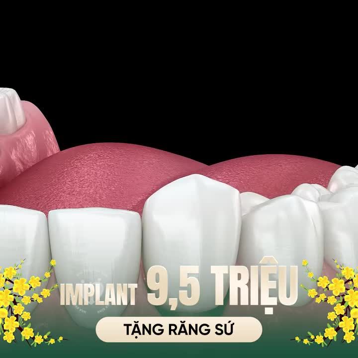 Trồng Implant - Ăn ngon trọn vẹn trước Tết, đừng để thiếu răng làm mất vui!