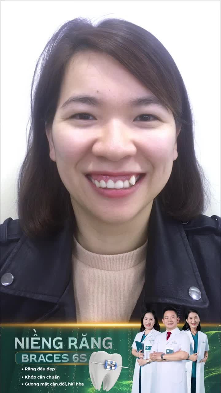 Trẻ ra chục tuổi sau niềng răng