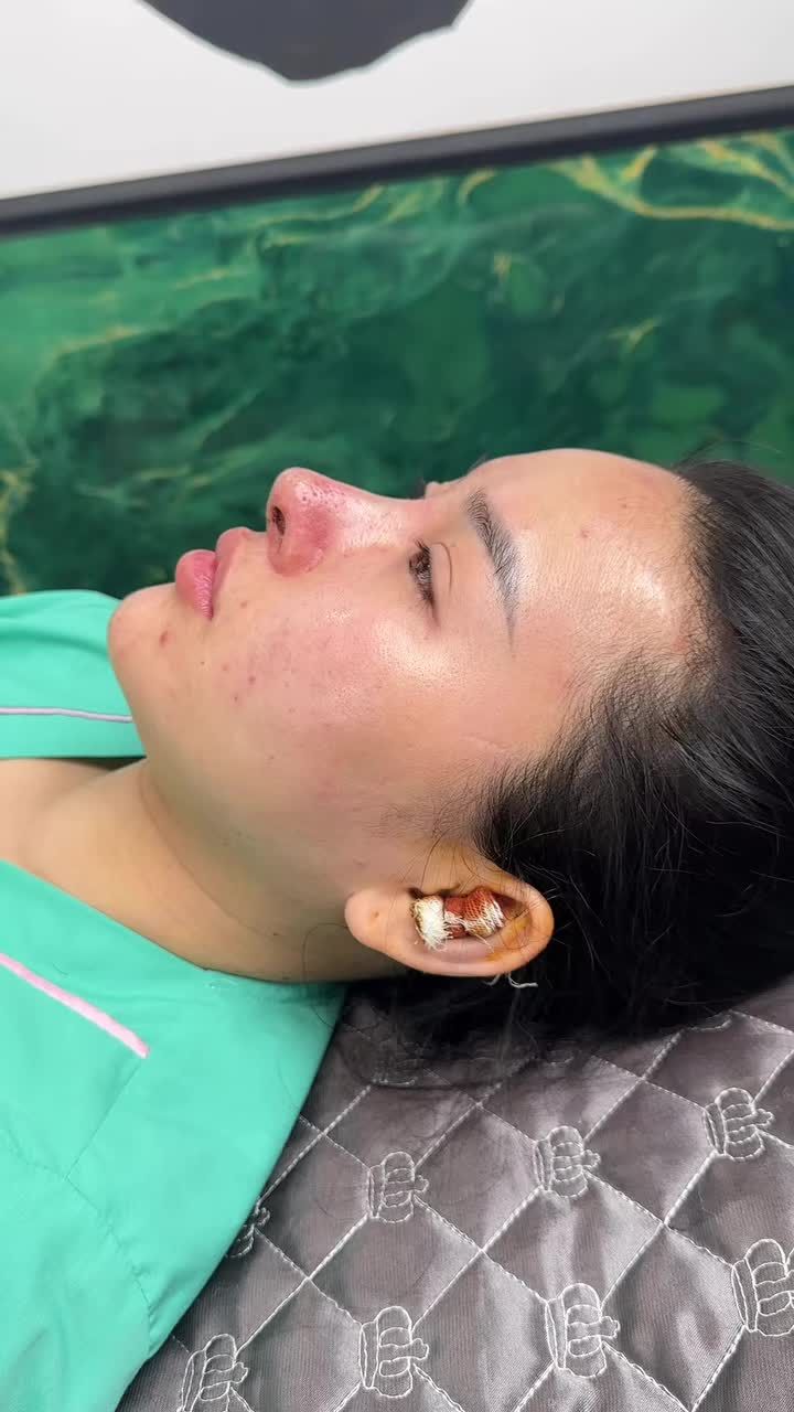 Mũi nâng cấp sau 5 sử dụng