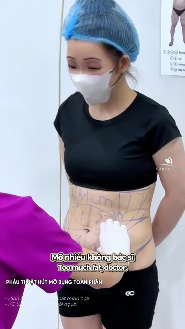 Bắt gặp 1 chị khách trong thang máy vừa phẫu thuật hút mỡ bụng toàn phần cách đây 1 ngày, cùng xem lại hành trình làm đẹp của chị nhé!