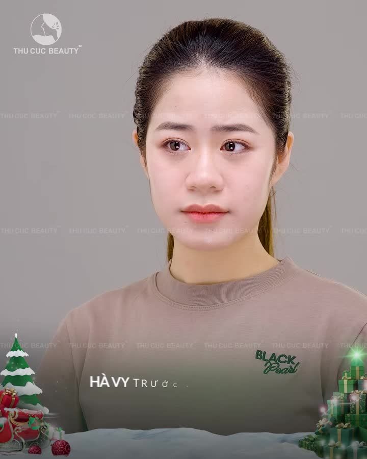 Đầu mũi to, cánh mũi bè Mũi TC Khắc phục mọi khuyết điểm về mũi