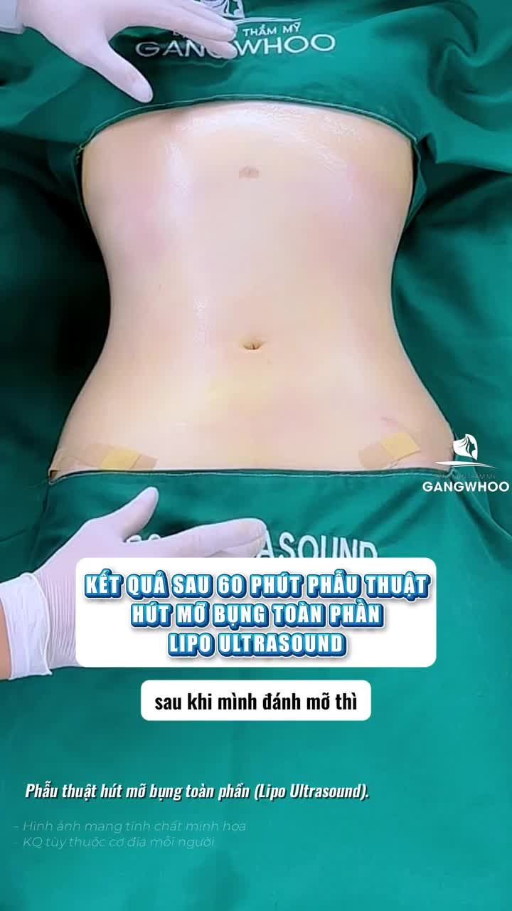 Bác sĩ phân tích kết quả sau 60 phút phẫu thuật hút mỡ bụng toàn phần (Lipo Ultrasound)