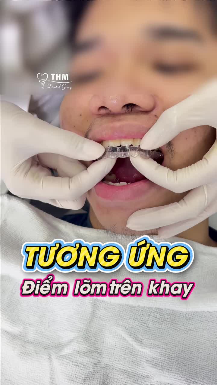 Chắc cũng có nhiều bạn thắc mắc qui trình lần đầu tiên mang niềng Invisalign là như thế nào , ở trong clip này Nha Khoa Thế Hệ Mới và Bs CKI Nguyễn Phương Thảo chia sẻ qui trình này cho mọi người nhé