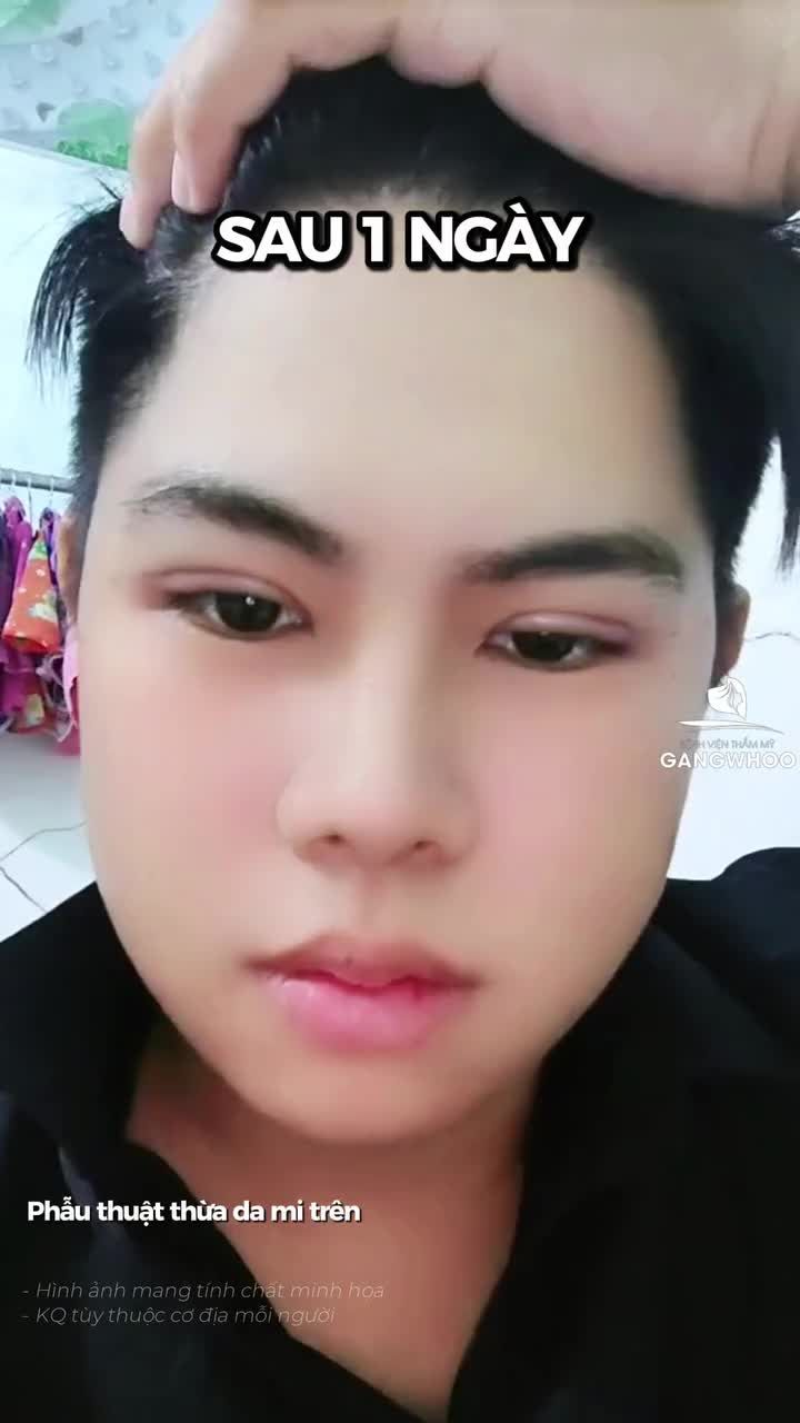 Ngày đầu sau khi cắt mí và kết quả sau 7 ngày sẽ trông như thế nào? Cùng Gangwhoo đón xem nhé!