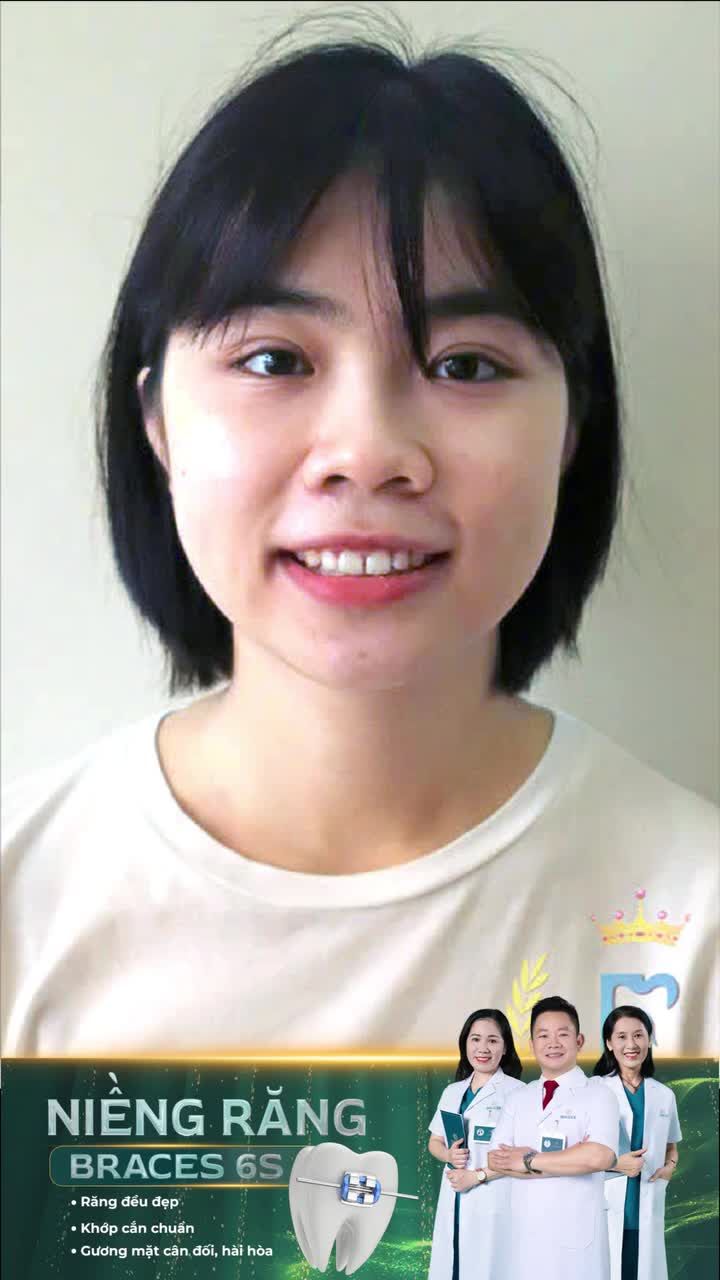 Bất ngờ sau khi niềng răng